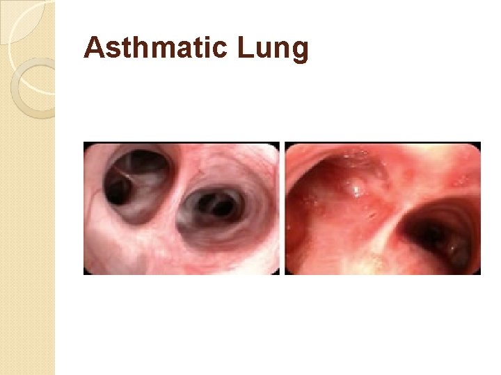 Asthmatic Lung 