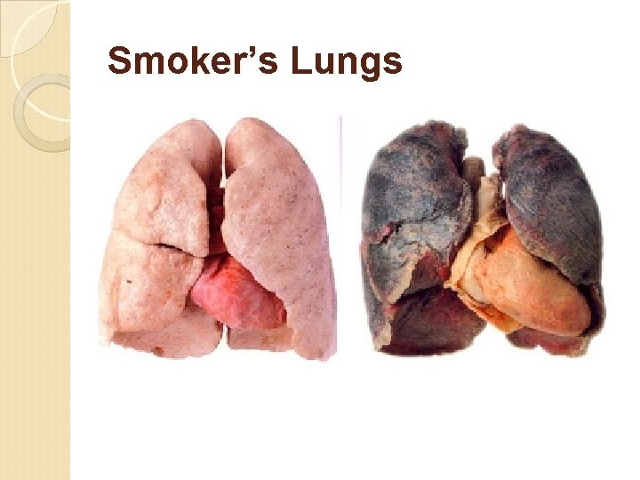 Smoker’s Lungs 