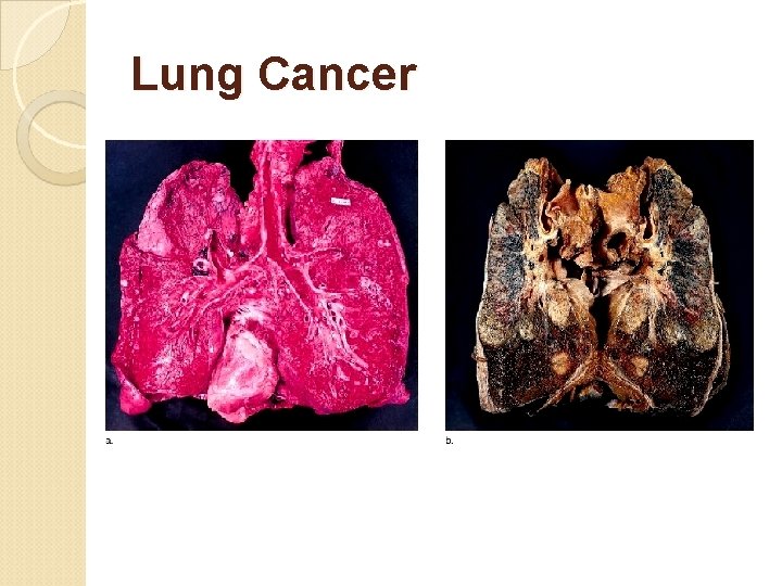 Lung Cancer 