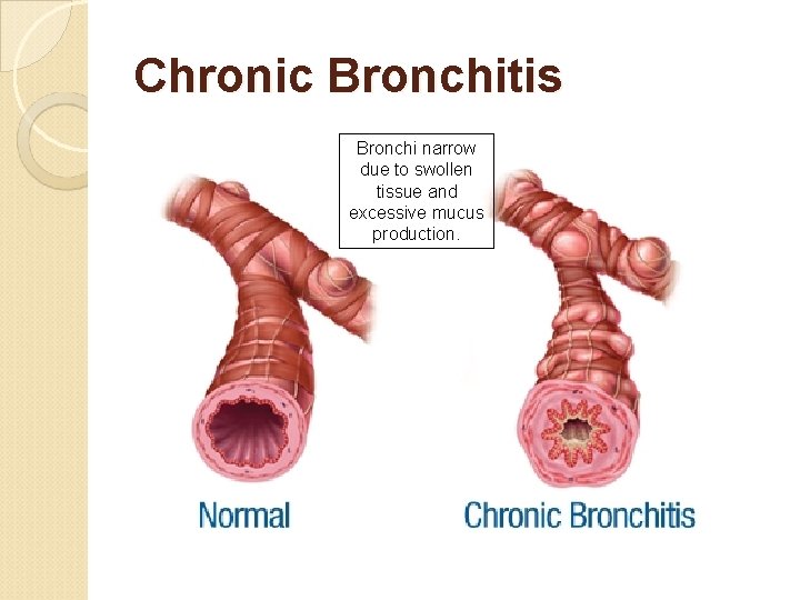 Chronic Bronchitis Bronchi narrow due to swollen tissue and excessive mucus production. 