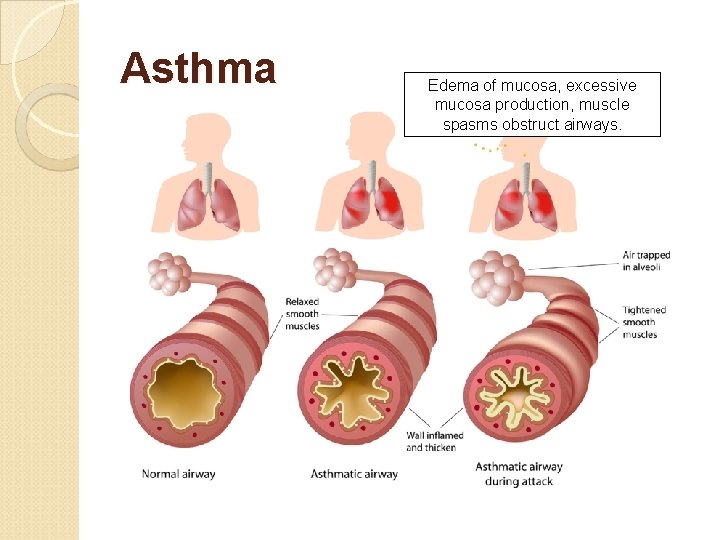 Asthma Edema of mucosa, excessive mucosa production, muscle spasms obstruct airways. 