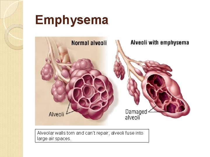 Emphysema Alveolar walls torn and can’t repair, alveoli fuse into large air spaces. 