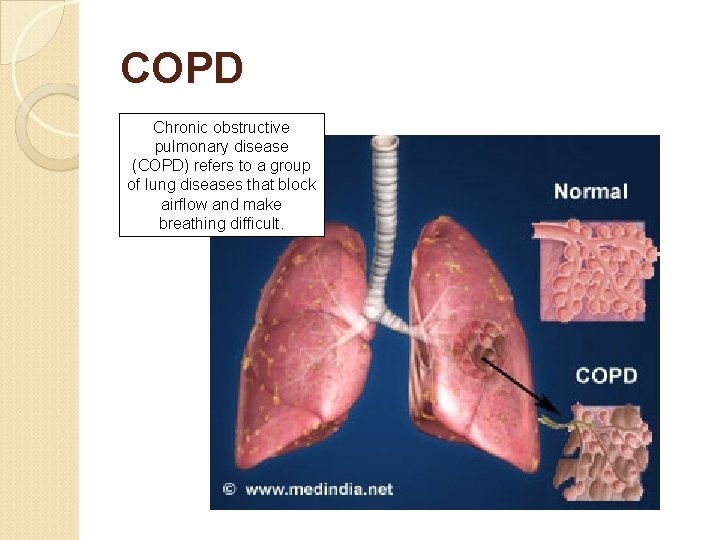 COPD Chronic obstructive pulmonary disease (COPD) refers to a group of lung diseases that