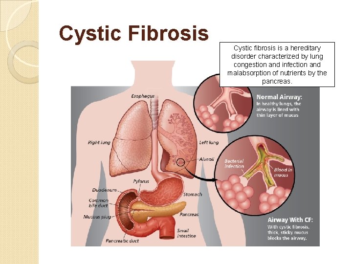 Cystic Fibrosis Cystic fibrosis is a hereditary disorder characterized by lung congestion and infection