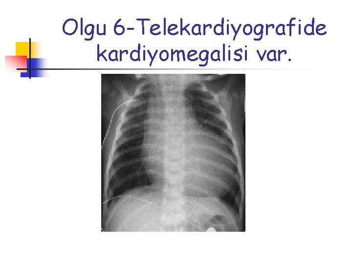 Olgu 6 -Telekardiyografide kardiyomegalisi var. 