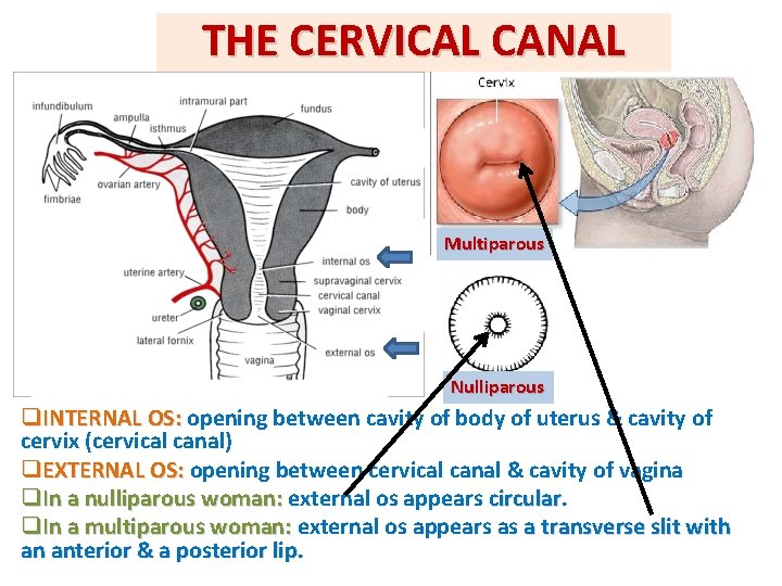 THE CERVICAL CANAL Multiparous Nulliparous q. INTERNAL OS: opening between cavity of body of