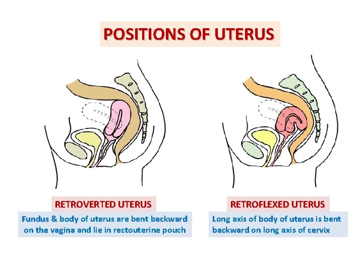 POSITIONS OF UTERUS RETROVERTED UTERUS RETROFLEXED UTERUS Fundus & body of uterus are bent