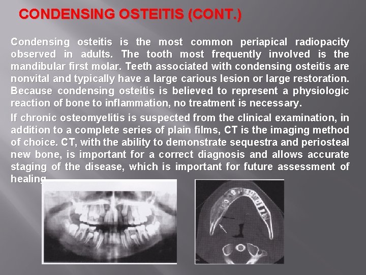 CONDENSING OSTEITIS (CONT. ) Condensing osteitis is the most common periapical radiopacity observed in