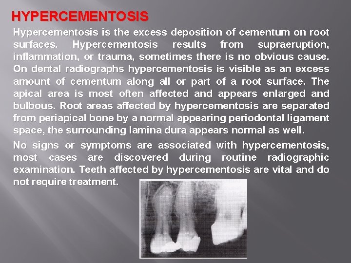 HYPERCEMENTOSIS Hypercementosis is the excess deposition of cementum on root surfaces. Hypercementosis results from