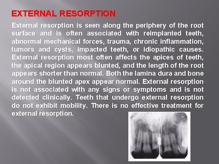 EXTERNAL RESORPTION External resorption is seen along the periphery of the root surface and