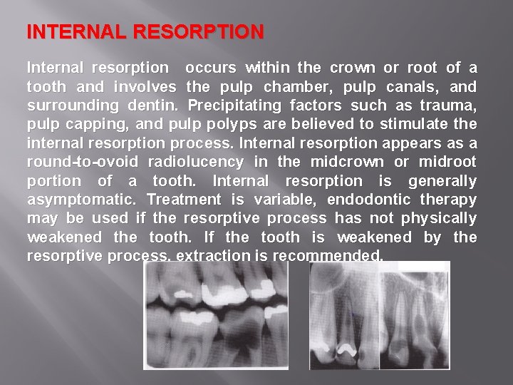 INTERNAL RESORPTION Internal resorption occurs within the crown or root of a tooth and