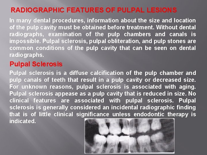 RADIOGRAPHIC FEATURES OF PULPAL LESIONS In many dental procedures, information about the size and