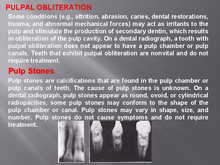 PULPAL OBLITERATION Some conditions (e. g. , attrition, abrasion, caries, dental restorations, trauma, and