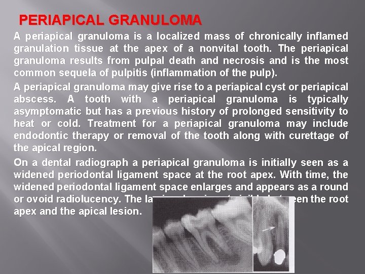 PERIAPICAL GRANULOMA A periapical granuloma is a localized mass of chronically inflamed granulation tissue