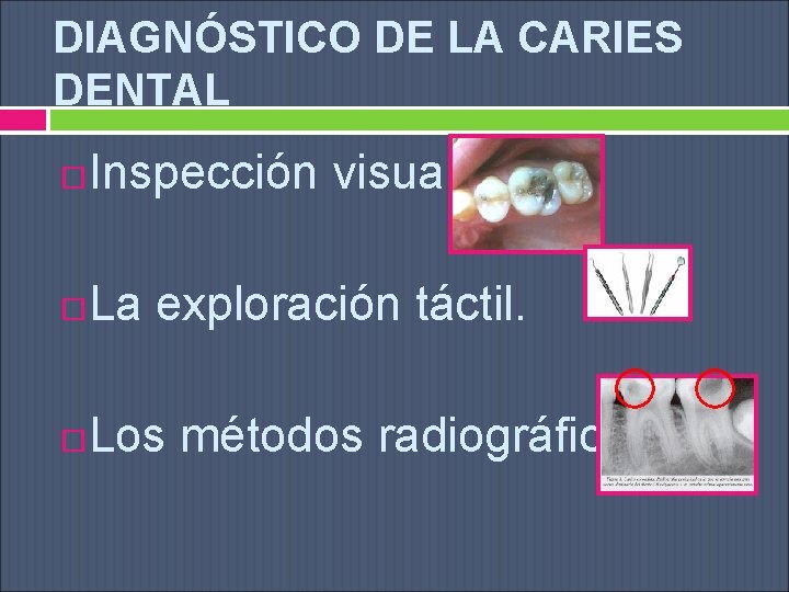 DIAGNÓSTICO DE LA CARIES DENTAL Inspección visual La exploración táctil. Los métodos radiográficos 