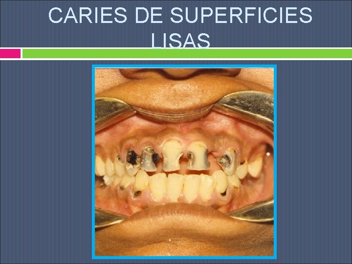CARIES DE SUPERFICIES LISAS 