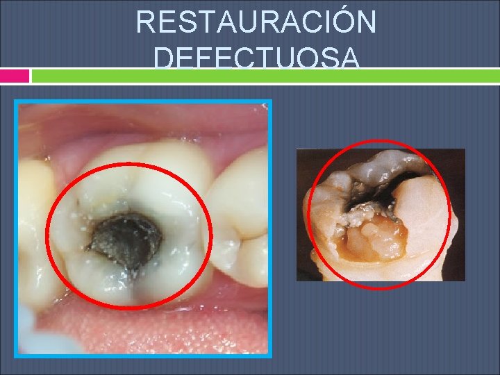 RESTAURACIÓN DEFECTUOSA 