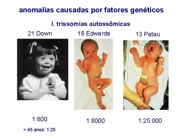 anomalias causadas por fatores genéticos I. trissomias autossômicas 21 Down 18 Edwards 1: 8000