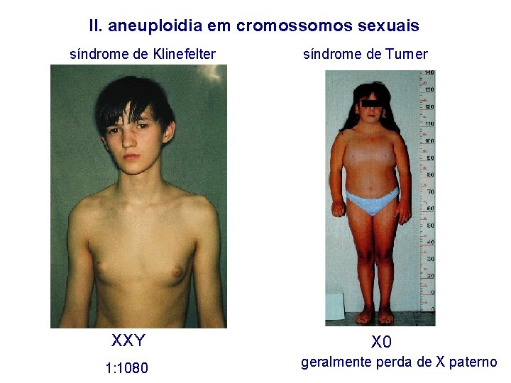 II. aneuploidia em cromossomos sexuais síndrome de Klinefelter XXY 1: 1080 síndrome de Turner