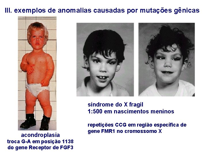 III. exemplos de anomalias causadas por mutações gênicas síndrome do X fragil 1: 500