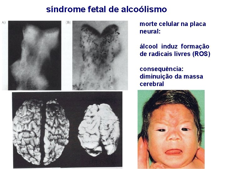 síndrome fetal de alcoólismo morte celular na placa neural: álcool induz formação de radicais