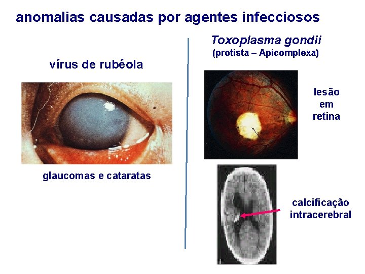 anomalias causadas por agentes infecciosos Toxoplasma gondii vírus de rubéola (protista – Apicomplexa) lesão