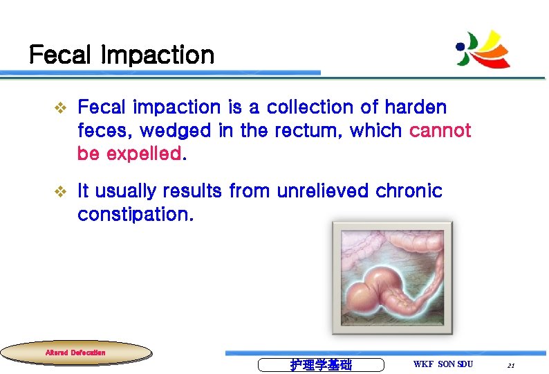 Fecal Impaction v Fecal impaction is a collection of harden feces, wedged in the