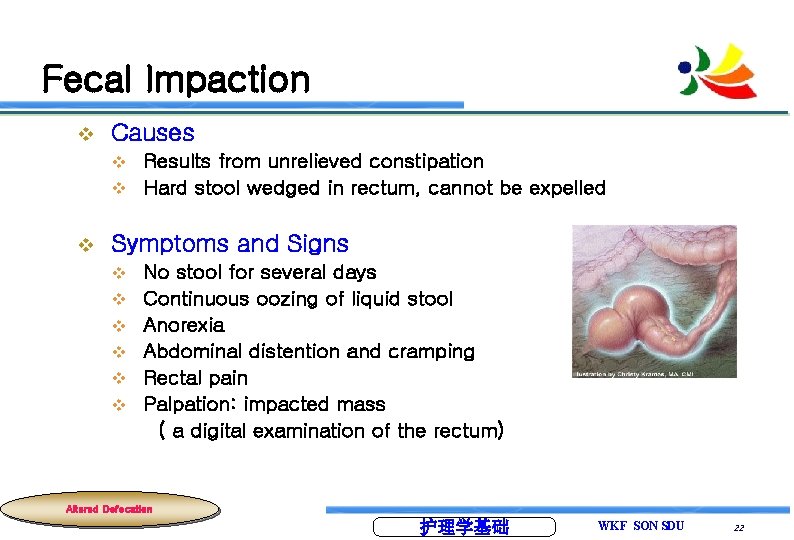 Fecal Impaction v Causes Results from unrelieved constipation v Hard stool wedged in rectum,