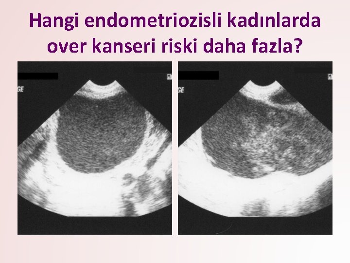 Hangi endometriozisli kadınlarda over kanseri riski daha fazla? 