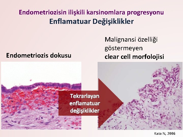 Endometriozisin ilişkili karsinomlara progresyonu Enflamatuar Değişiklikler Endometriozis dokusu Malignansi özelliği göstermeyen clear cell morfolojisi