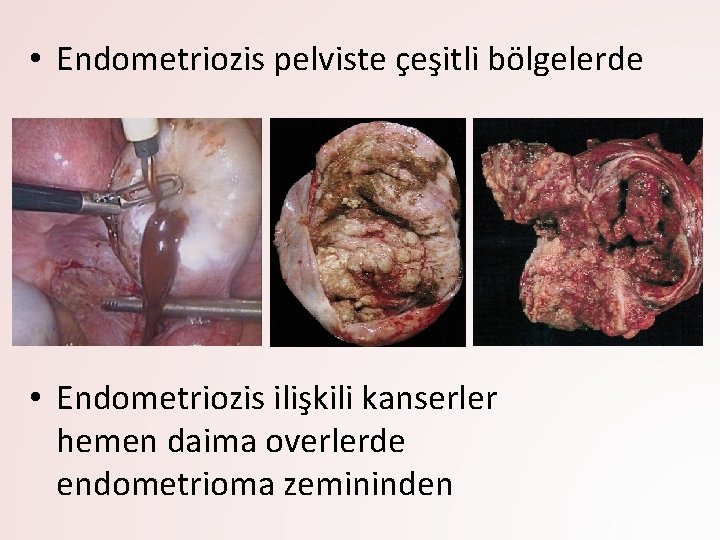  • Endometriozis pelviste çeşitli bölgelerde • Endometriozis ilişkili kanserler hemen daima overlerde endometrioma