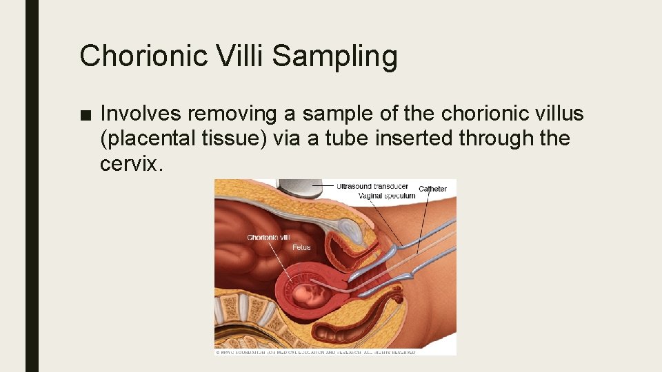 Chorionic Villi Sampling ■ Involves removing a sample of the chorionic villus (placental tissue)