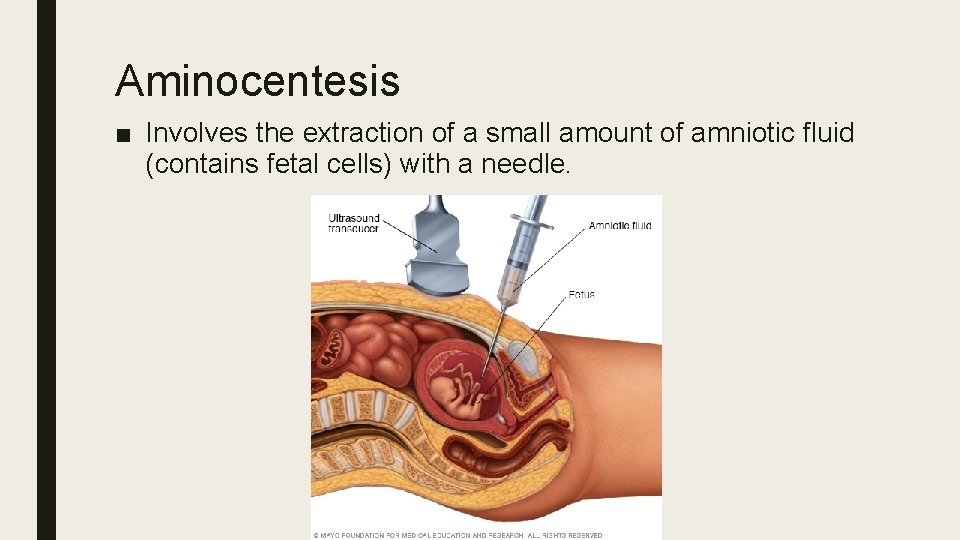 Aminocentesis ■ Involves the extraction of a small amount of amniotic fluid (contains fetal