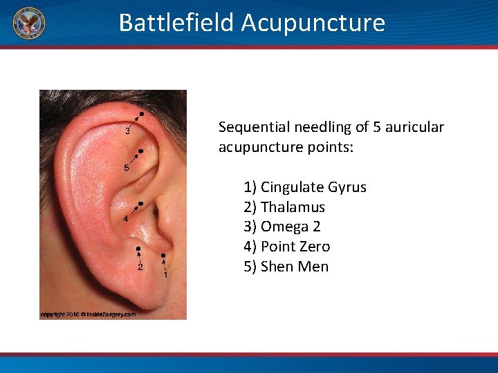 Battlefield Acupuncture Sequential needling of 5 auricular acupuncture points: 1) Cingulate Gyrus 2) Thalamus