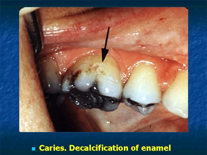 Caries. Decalcification of enamel Caries. Decalcification of enamel