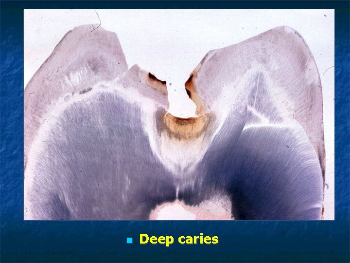 Deep caries Deep caries