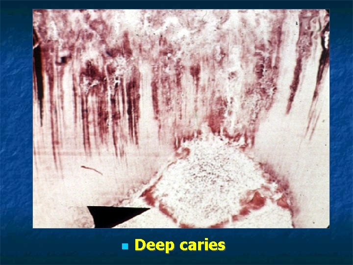 Deep caries Deep caries