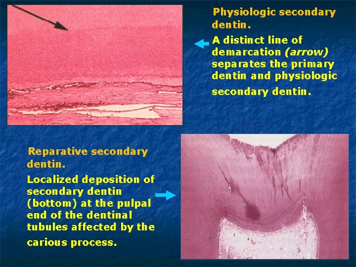 Physiologic secondary dentin. A distinct line of demarcation (arrow) separates the primary dentin and Physiologic secondary dentin. A distinct line of demarcation (arrow) separates the primary dentin and
