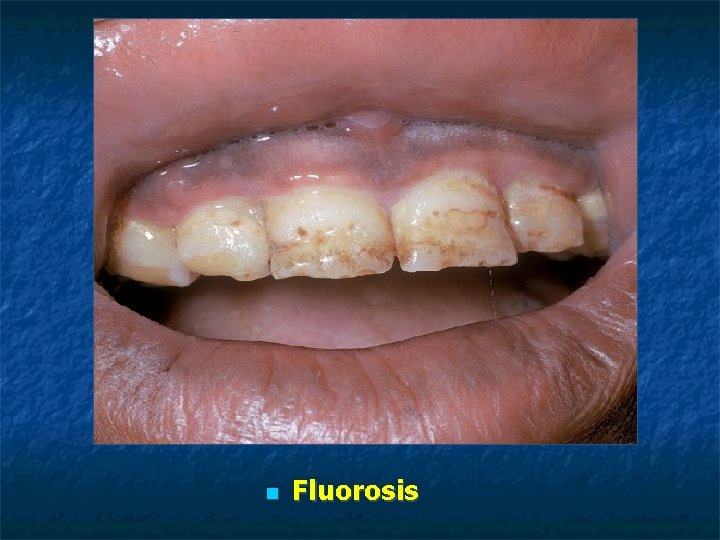 Fluorosis Fluorosis