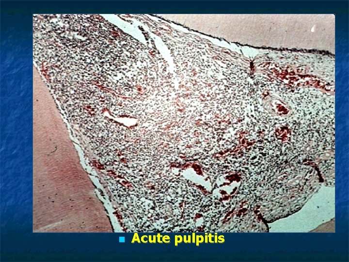 Acute pulpitis Acute pulpitis