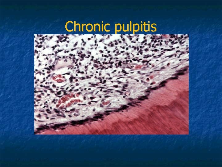 Chronic pulpitis Chronic pulpitis