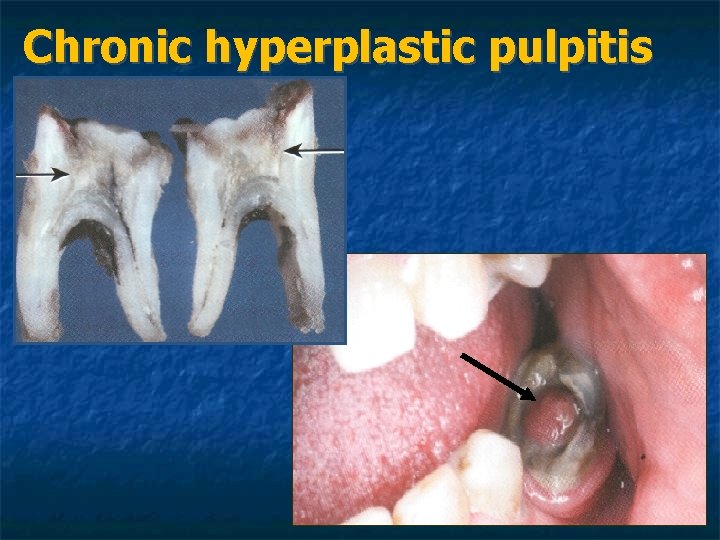 Chronic hyperplastic pulpitis Chronic hyperplastic pulpitis