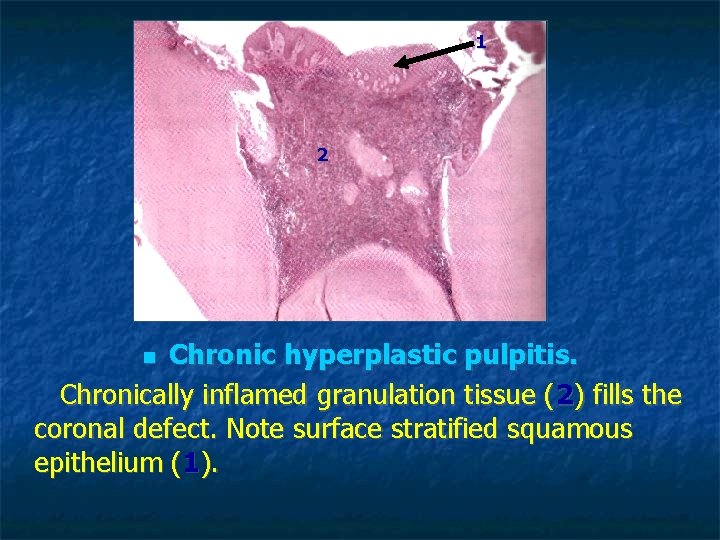 1 2 Chronic hyperplastic pulpitis. Chronically inflamed granulation tissue (2) fills the coronal defect. 1 2 Chronic hyperplastic pulpitis. Chronically inflamed granulation tissue (2) fills the coronal defect.