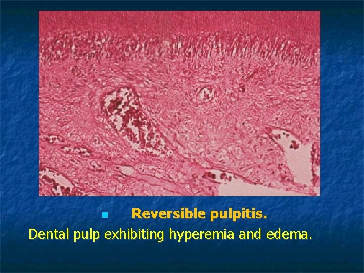 Reversible pulpitis. Dental pulp exhibiting hyperemia and edema. Reversible pulpitis. Dental pulp exhibiting hyperemia and edema.