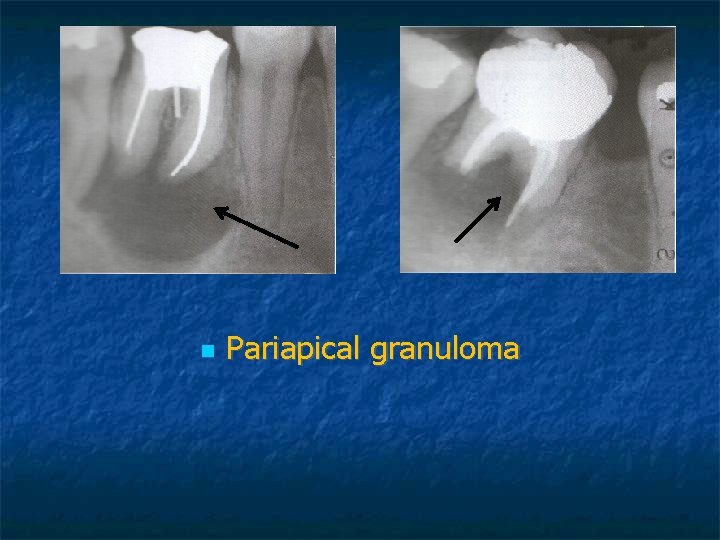 Pariapical granuloma Pariapical granuloma