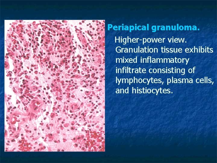 Periapical granuloma. Higher-power view. Granulation tissue exhibits mixed inflammatory infiltrate consisting of lymphocytes, plasma Periapical granuloma. Higher-power view. Granulation tissue exhibits mixed inflammatory infiltrate consisting of lymphocytes, plasma