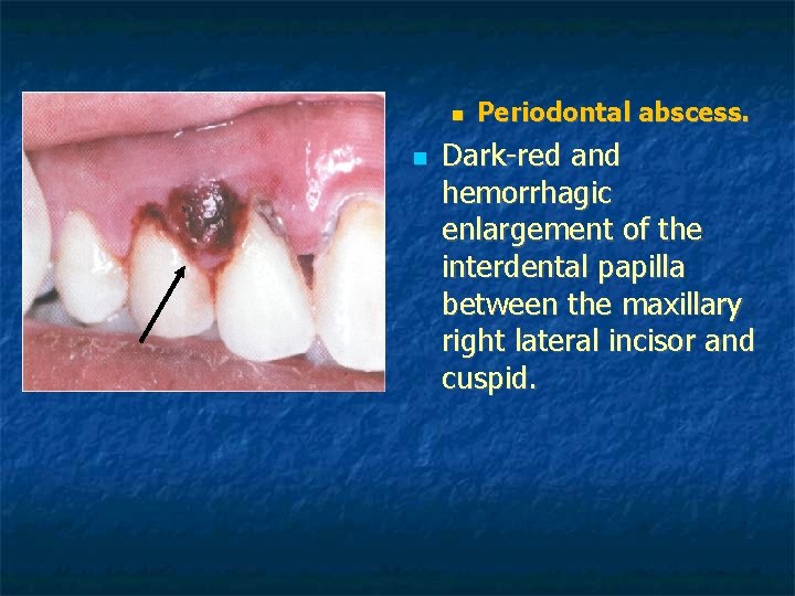 Periodontal abscess. Dark-red and hemorrhagic enlargement of the interdental papilla between the maxillary Periodontal abscess. Dark-red and hemorrhagic enlargement of the interdental papilla between the maxillary