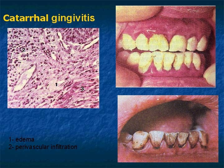 Catarrhal gingivitis 1 - edema 2 - perivascular infiltration Catarrhal gingivitis 1 - edema 2 - perivascular infiltration