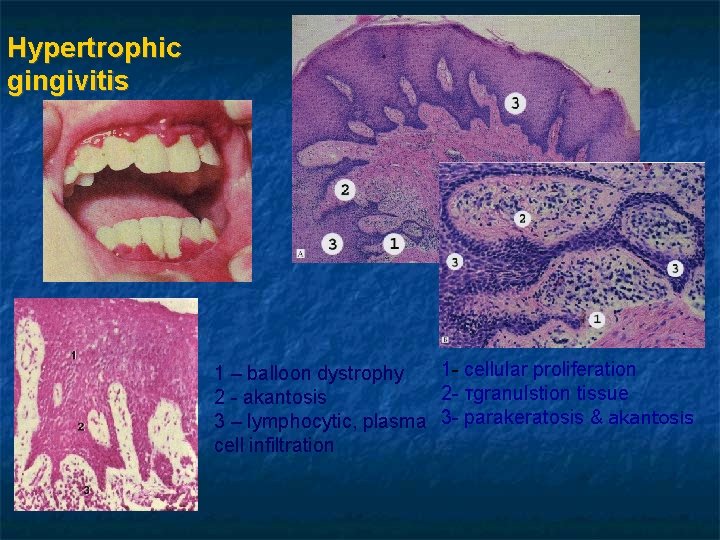 Hypertrophic gingivitis 1 - cellular proliferation 1 – balloon dystrophy 2 - тgranulstion tissue Hypertrophic gingivitis 1 - cellular proliferation 1 – balloon dystrophy 2 - тgranulstion tissue