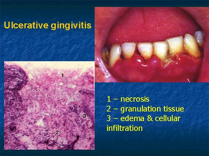 Ulcerative gingivitis 1 – necrosis 2 – granulation tissue 3 – edema & cellular Ulcerative gingivitis 1 – necrosis 2 – granulation tissue 3 – edema & cellular